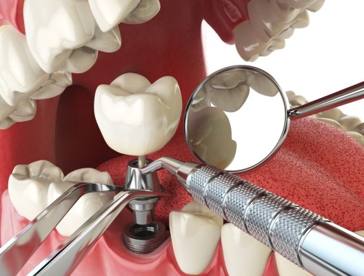 Cấy ghép implant