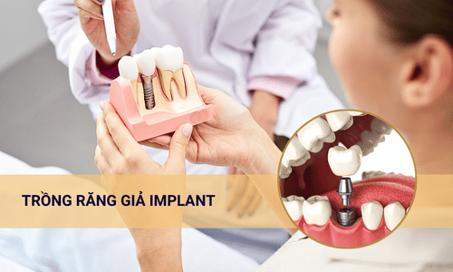 Trồng răng giả implant